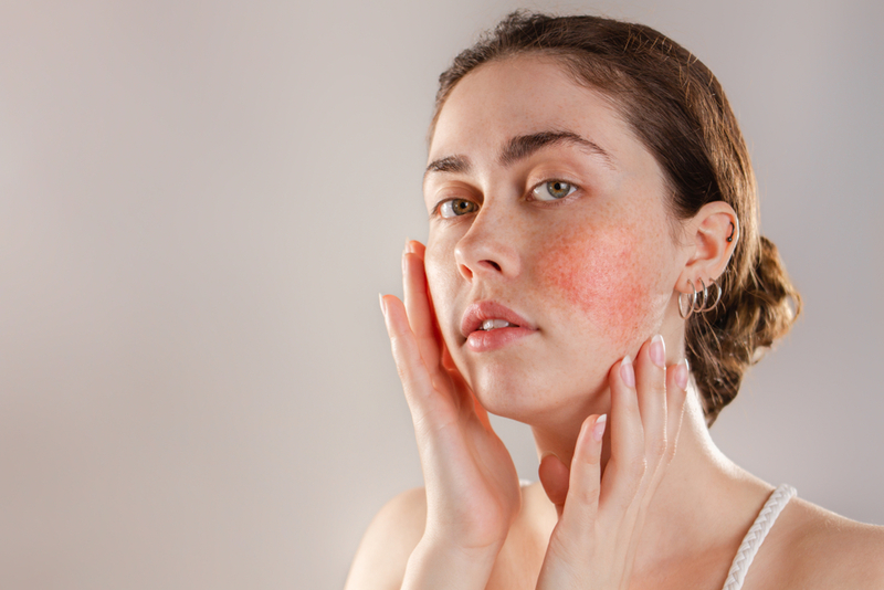 Relieve Rosacea | Shutterstock