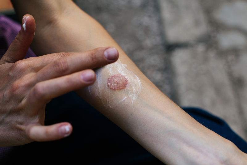 Run Rings Around the Ringworm | Shutterstock